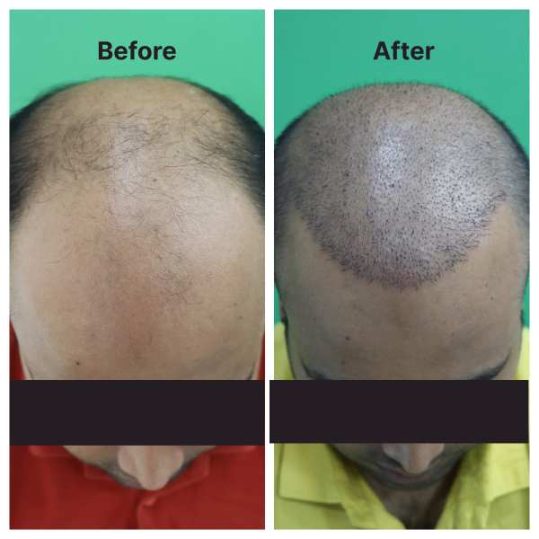 Hair Transplant result KOQ10